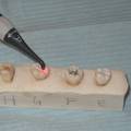 两项诊断牙体脱矿程度的新技术--关系研究