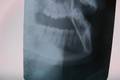 下颌第三磨牙高位阻生非拔除治疗36例临床观察