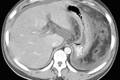 急性胰腺炎累及胃裸区的MSCT表现及其与Balthazar CT分级的相关性研究 	 