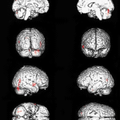 缺血性中风患者外关穴巨刺fMRI脑功能成像的研究
