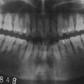 上颌第一磨牙的相关测量及临床意义