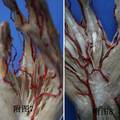 拇指掌侧主要动脉的分型及其灌注标本的制作