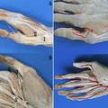 拇指掌侧主要动脉的分型及其灌注标本的制作