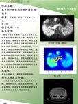 基于PET图像的肝脏肿瘤分割技术